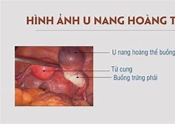 Đặc Điểm Của Hoàng Thể Thai Nghén